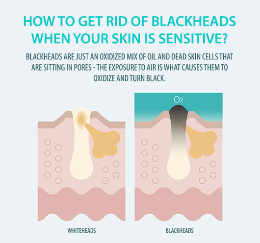 sensitive skin blackheads